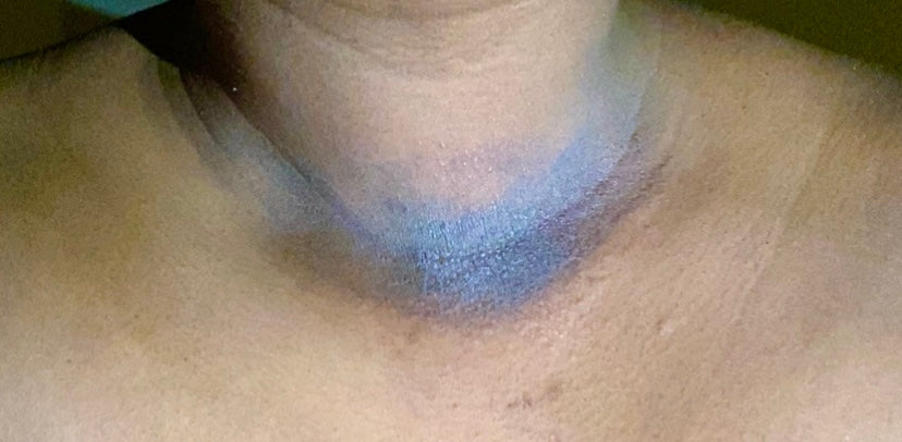 Before applying our Organic Blemish Butter to an eczema flare up. No broken skin or bleeding present.